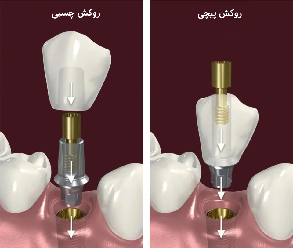 روکش چسبی بهتره یا پیچی