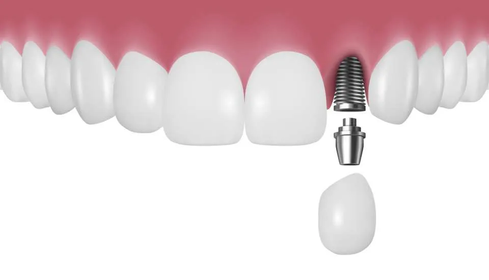 ایمپلنت یک مرحله ای زودتر است