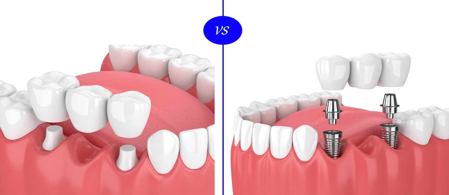 ایمپلنت خوبه یا بریج؟