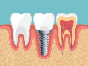 مقایسه ریشه ایمپلنت و دندان طبیعی