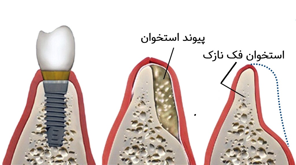 چرایی پیوند استخوان در فک