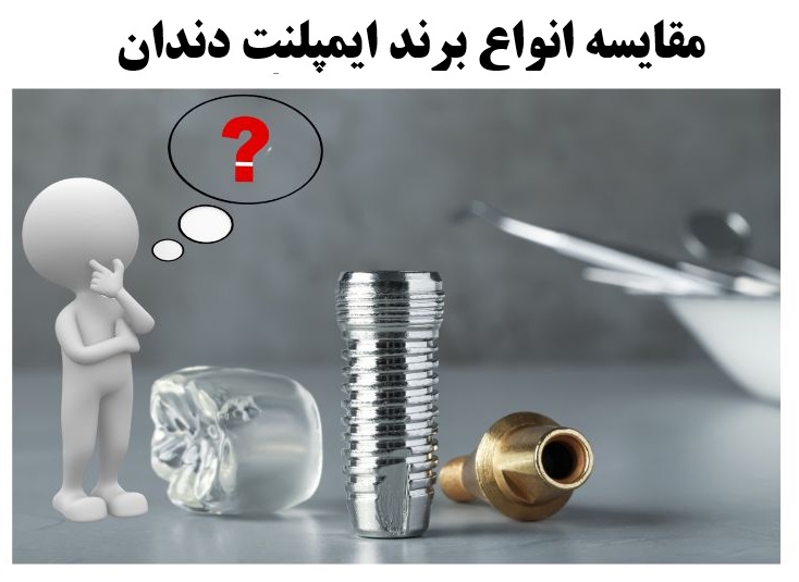 مقایسه انواع برند ایمپلنت دندان