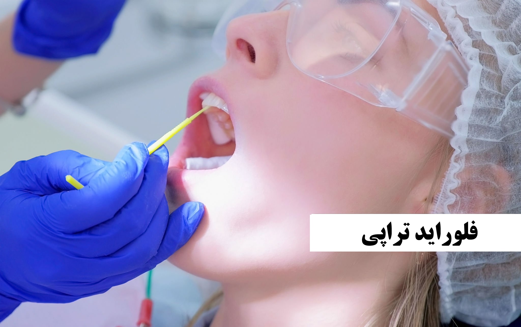 فلوراید تراپی
