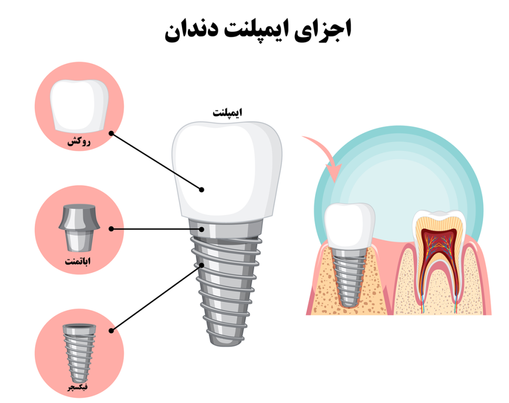 اجزای ایمپلنت دندان