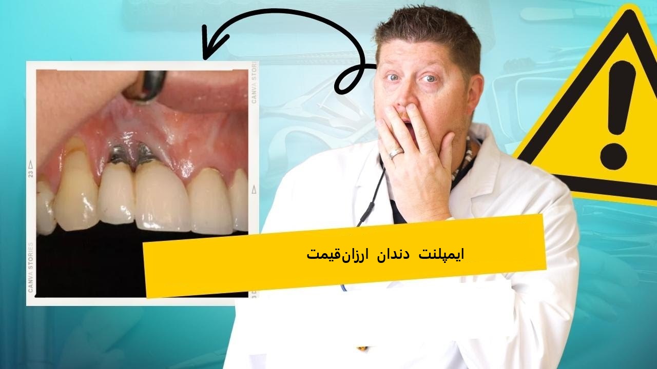 ایمپلنت ارزان قیمت