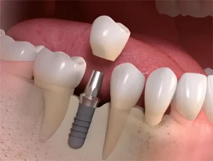 ایمپلنت Roxolid استرومن