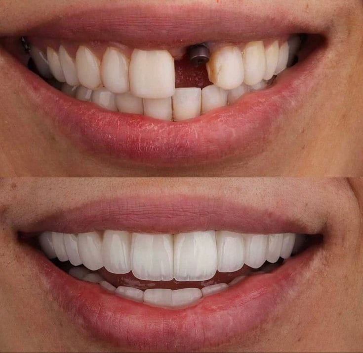 ایمپلنت برای دندان های جلو 