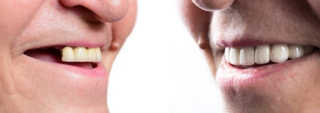 نقش ایمپلنت دندان در حفظ جوانی چهره و جلوگیری از پیری زودرس