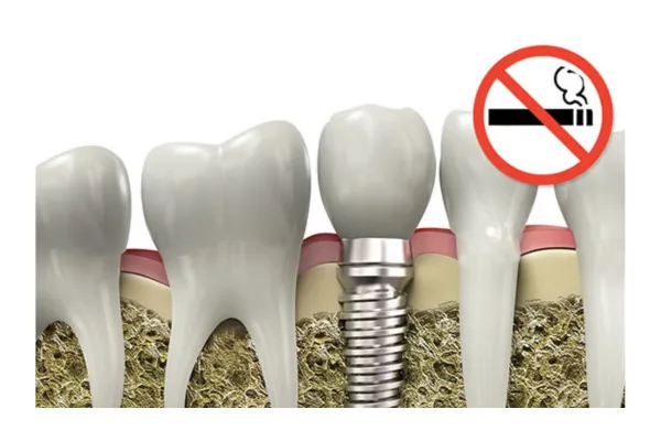 تاثیر سیگار و دیابت بر موفقیت و هزینه ایمپلنت دندان