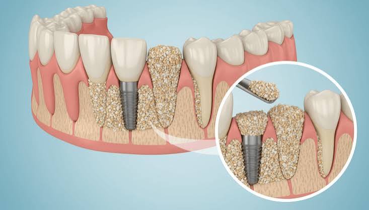 بررسی تخصصی مکانیسم‌های کلینیکی و پروتکل‌های پیشرفته مدیریت عوارض پس از جراحی ایمپلنت دندان