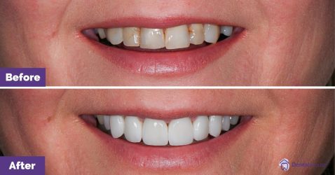 Dental-House-Group_Zoe_Smile-Makeover-Journey