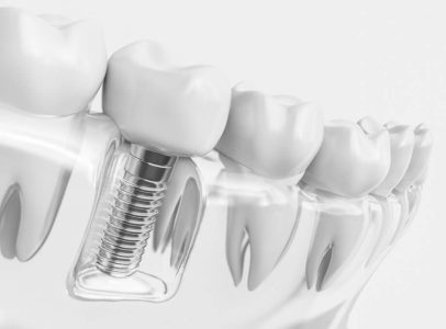 Implant-vs-Crown-Pros-Cons-920x680