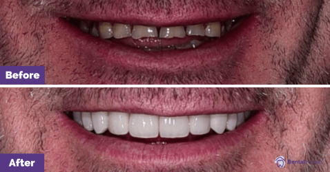 Jako_Porcelain-veneers_Melbourne_Dental-House