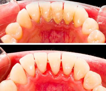 dental-scaling-before-after1